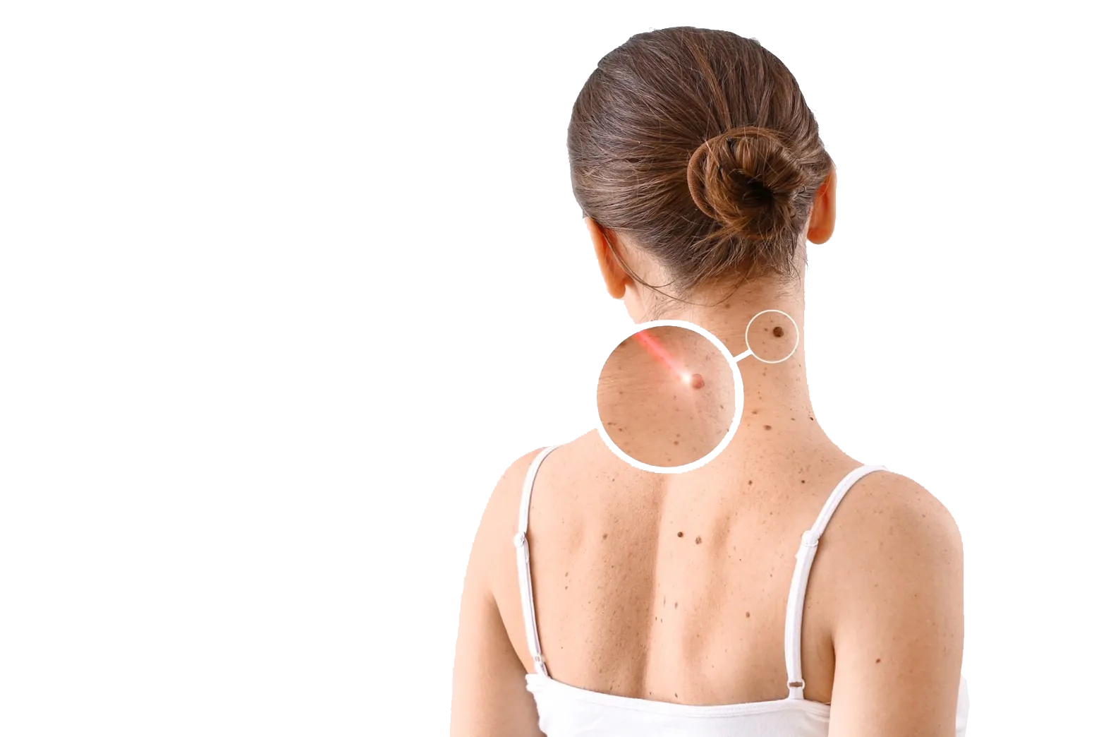 İzmir Lazerle Ben Alma Tedavisi - Dermatolog Dr. Sedef Demirer, İzmir