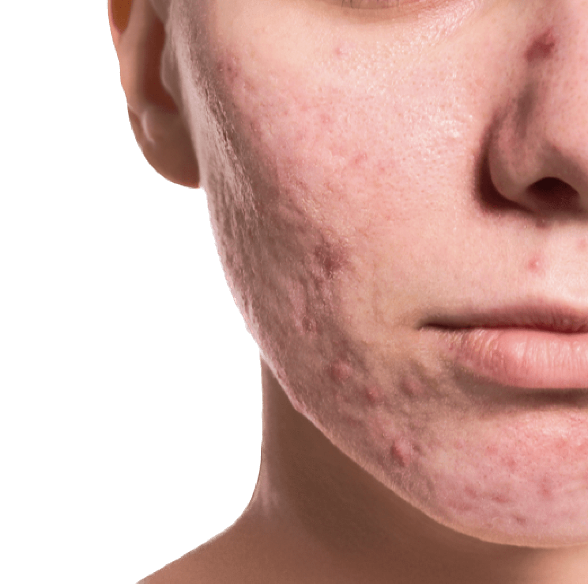 İzmir Lazerle Akne İzi Tedavisi - Dermatolog Dr. Sedef Demirer, İzmir